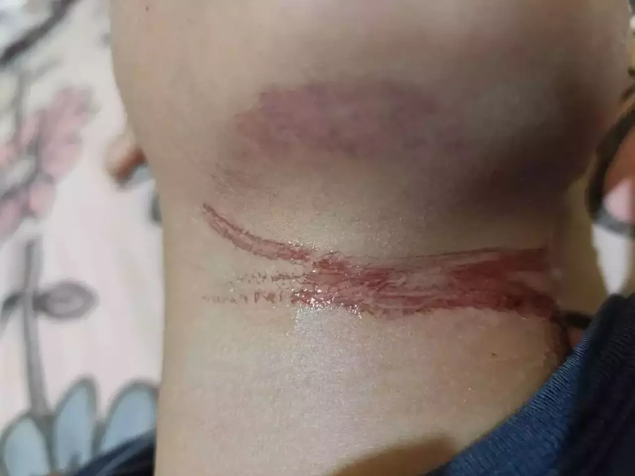 Fio solto fere pescoço de criança quando saia de escola municipal